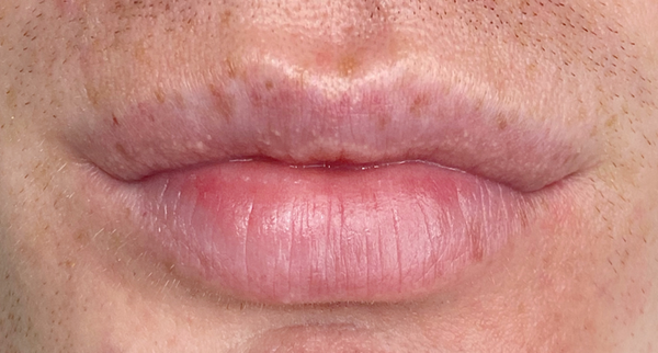 Case Study: Men’s Lip Blushing